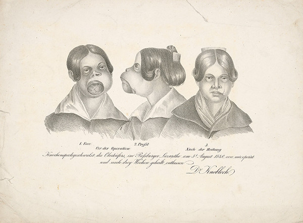 Rakúsky grafik z 19. storočia – Pred a po plastickej operácii 